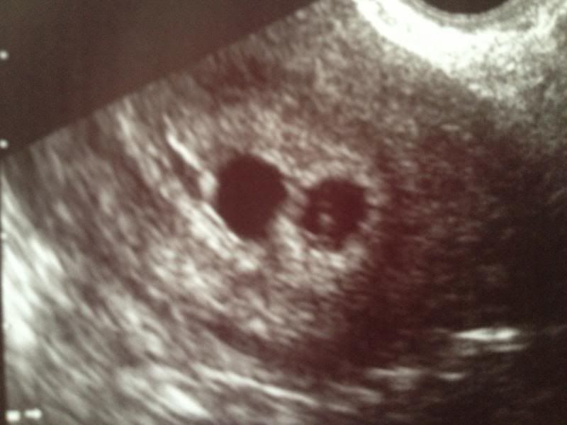6w0d ultrasound shocker babycenter photo photo jpg